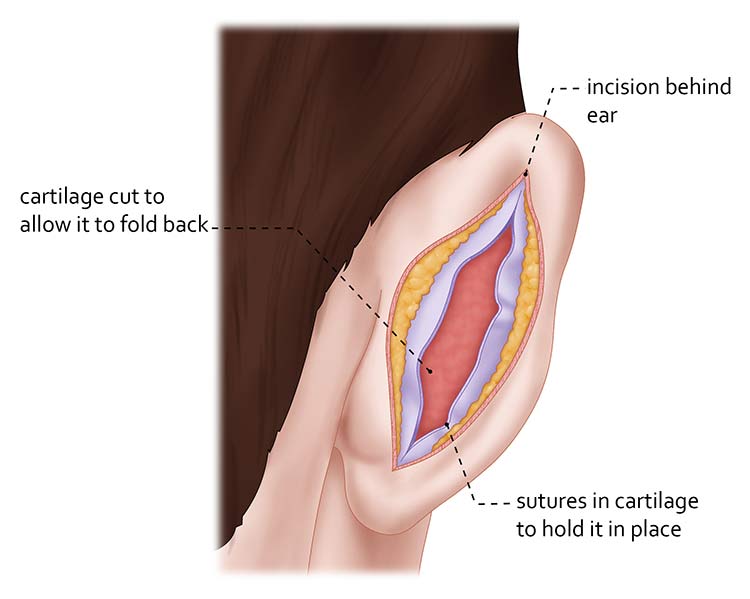 Protruding-Ears-(Otoplasty)